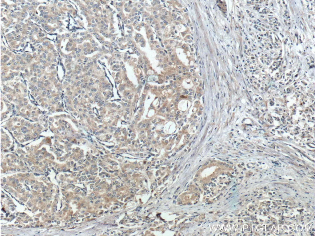 IHC staining of human prostate cancer using PTEN polyclonal antibody