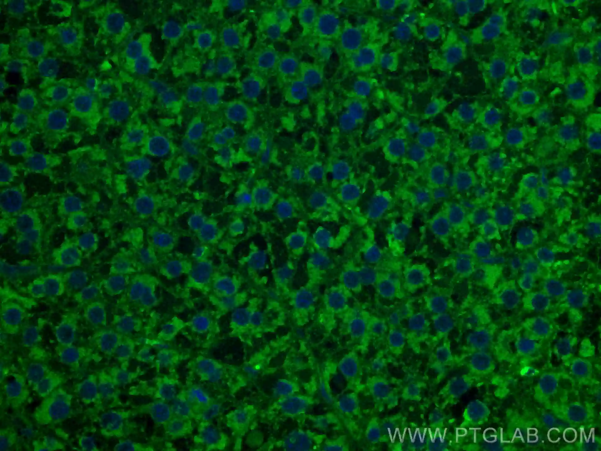 Immunofluorescent (IF) analysis of (4% PFA) fixed human liver cancer tissue using CoraLite® Plus 488 TNFR1 antibody (CL488-60192) at dilution of 1:200.