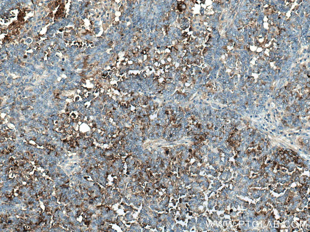 IHC staining of human ovary tumor using HE4 polyclonal antibody