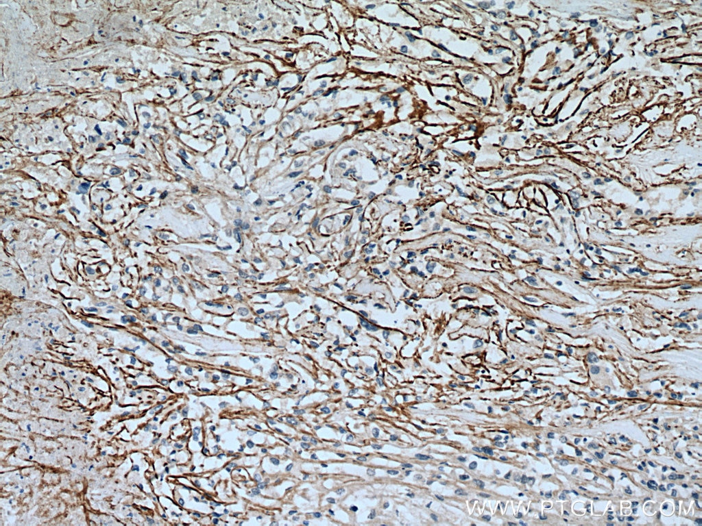 Immunohistochemistry (IHC) staining of human renal cell carcinoma tissue using SLC7A11/xCT Polyclonal antibody (26864-1-AP)