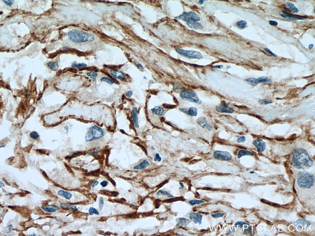 Immunohistochemistry (IHC) staining of human renal cell carcinoma tissue using SLC7A11/xCT Polyclonal antibody (26864-1-AP)