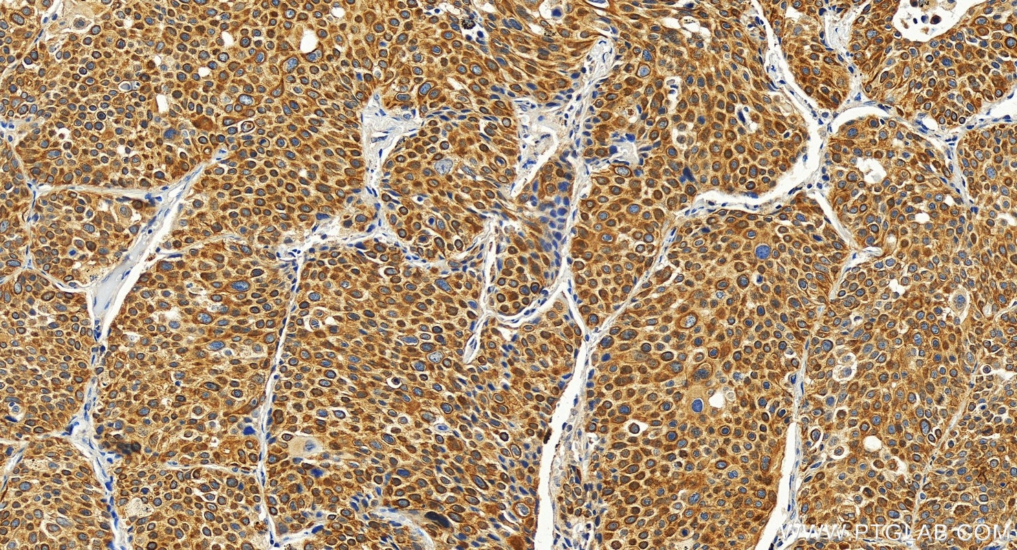 Immunohistochemistry (IHC) staining of human lung cancer tissue using SLC7A11/xCT Polyclonal antibody (26864-1-AP)